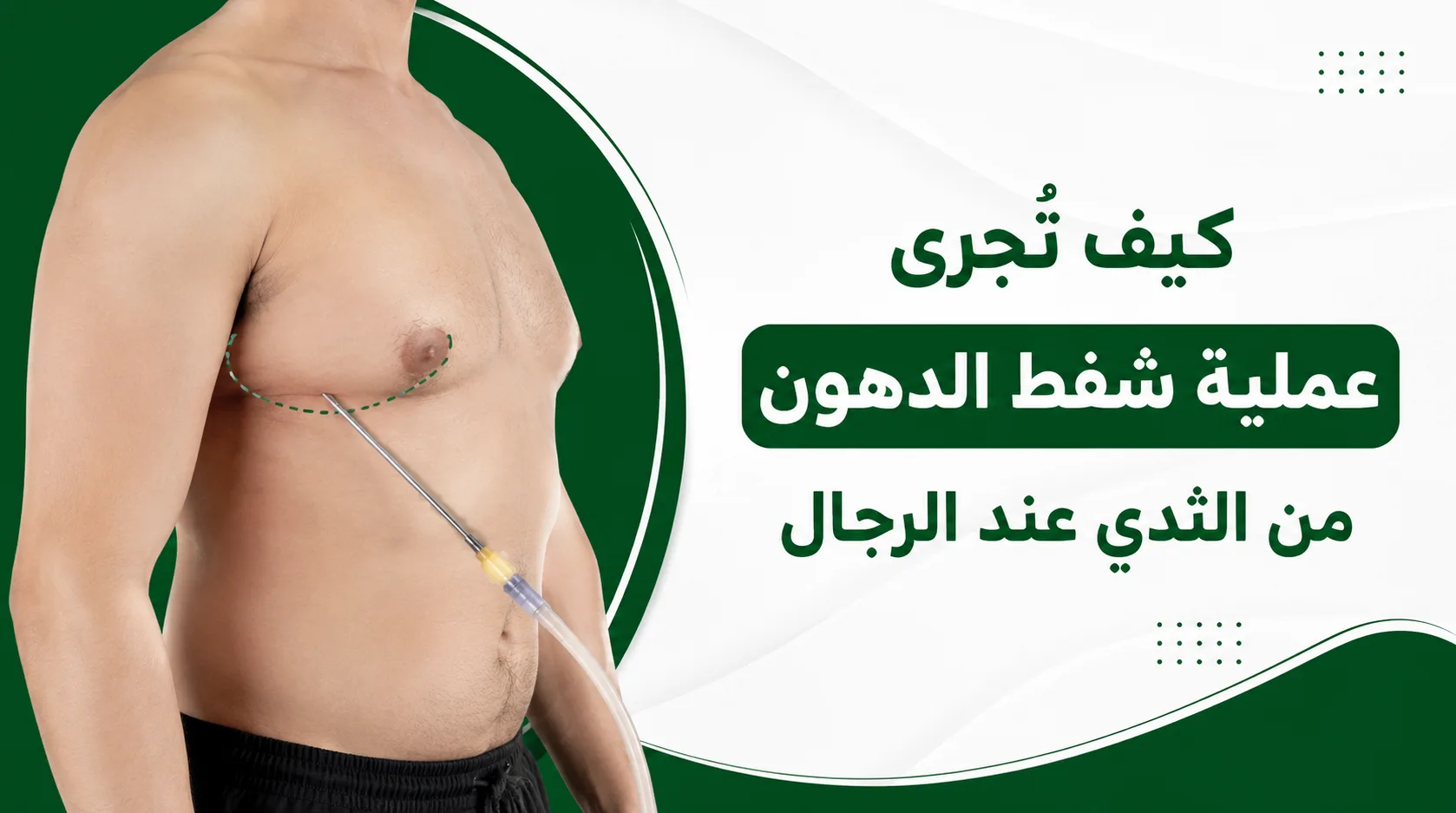 كيف تُجرى عملية شفط الدهون من الثدي عند الرجال